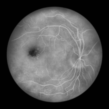 Best vitelliform macular dystrophy, stage 6 formation of a gliotic scar, scientific illustration, ophthalmoscope view, fluorescein angiography clipart