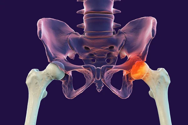 影响股骨头供血的儿童髋关节疾病Leg Calve Perthes病3D图片说明影响了左股骨头 图像的右侧 — 图库照片
