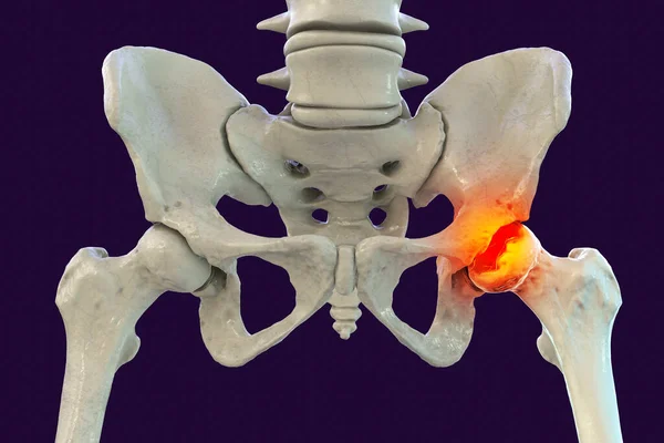 女性の頭部への血液供給に影響を与える小児の股関節疾患であるLegg Calve Pertes Diseaseの影響を受けた大腿骨骨の骨 3Dイラストは左大腿骨の骨に影響を与えます 画像の右側 — ストック写真
