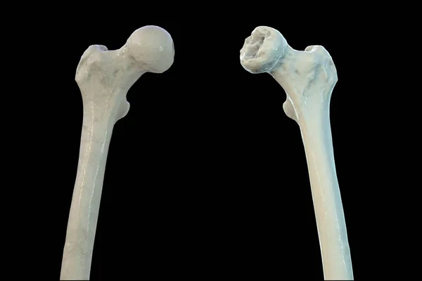 Femur Csont Által Érintett Legg Calve Perthes Betegség Egy Gyermekkori — Stock Fotó