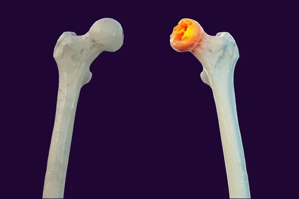 Femurknochen Betroffen Von Legg Calve Perthes Krankheit Einer Kindlichen Hüftstörung — Stockfoto