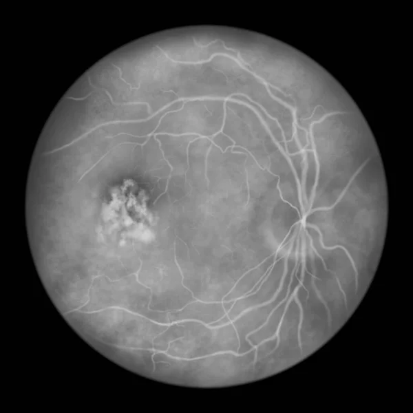 Best Vitelliform Macular Dystrophy Stage Vitelleruptive Scrambled Egg Appearance Scientific — Stock Photo, Image