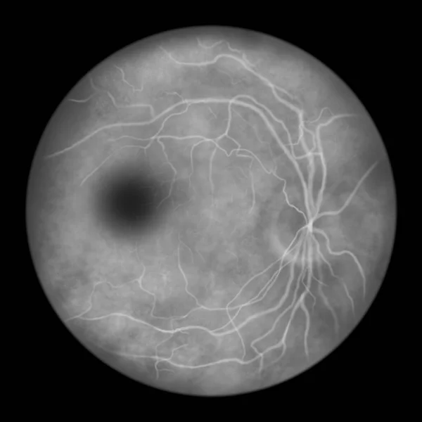 Best Vitelliform Macular Dystrophy Stage Atrophic Macular Atrophy Scientific Illustration — Stock Photo, Image