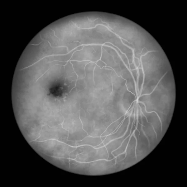 Best Vitelliform Macular Dystrophy Stage Formation Gliotic Scar Scientific Illustration — Stock Photo, Image