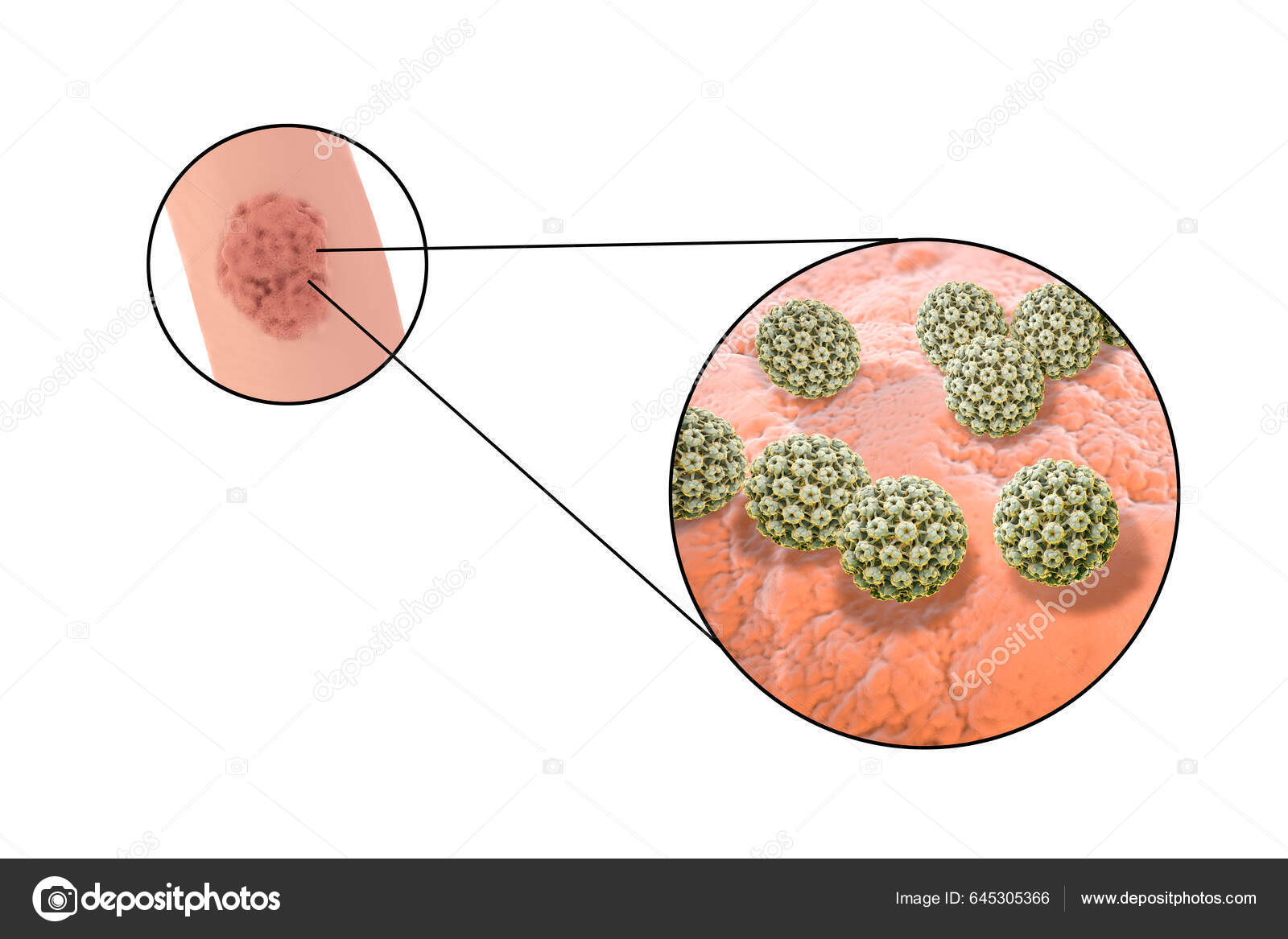 Human Papillomavirus Hpv Læsioner Hos Mænd Kønsvorter Close Visning Hpv —  Stock-foto © katerynakon #645305366