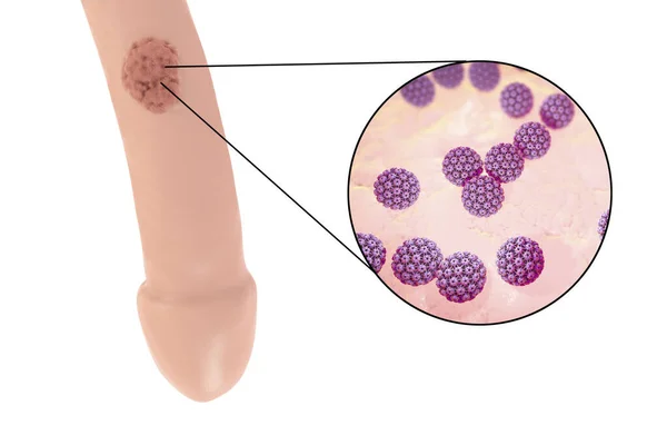 生殖器疣的常见部位 人类乳头瘤病毒在男性中的病变 以及Hpv的特写 3D插图 — 图库照片