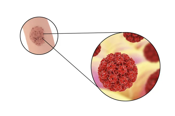 人类乳头瘤病毒 Hpv 在男性中的病变 生殖器疣和Hpv的特写 3D插图 — 图库照片