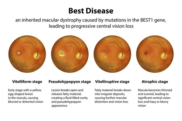 Stages Best Disease Best Vitelliform Macular Dystrophy Stages Description Ophthalmoscope — Stock Photo, Image