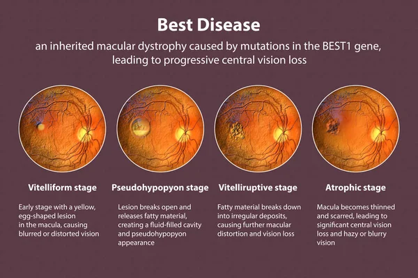 Stadien Der Besten Krankheit Beste Vitelliforme Makuladystrophie Stadien Mit Beschreibung — Stockfoto