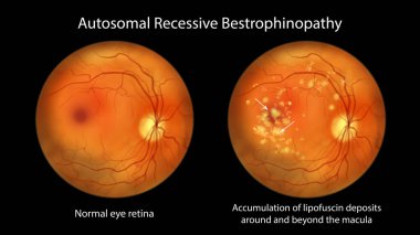 Otozomal çekinik bestrofenopati, normal göz retinası ve makula çevresinde ve ötesinde lipofusin birikintisinin retinada ilerleyen hasara yol açtığını gösteren bilimsel çizimler.