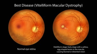 En iyi hastalık, göz retinası ve en iyi viteliform maküler distrofiyi gösteren illüstrasyon klasik yumurta sarısı lezyonuyla viteliform evresi, göz makyajı.