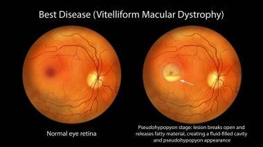 En iyi hastalık, göz retinası ve en iyi viteliform maküler distrofiyi gösteren illüstrasyon, lipofusin katmanlı psödohipopyon aşaması, oftalmoskop görüntüsü