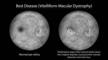 En iyi hastalık, normal göz retinası ve en iyi viteliform maküler distrofiyi gösteren illüoresein anjiyografisinde çırpılmış yumurta görünümlü vitelleruptive evre.