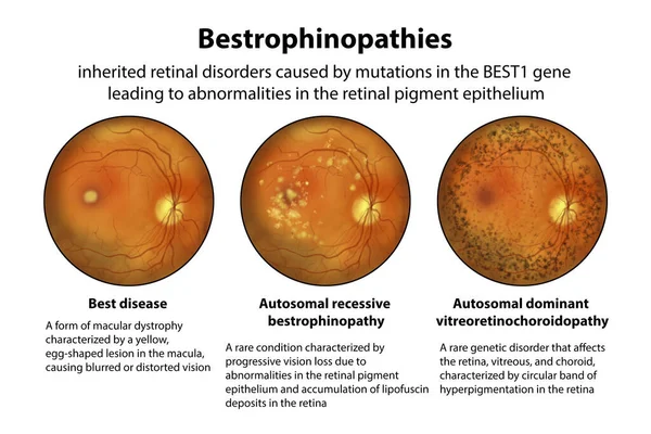 Bestrophinopathies Inherited Retinal Disorders Caused Mutations Best1 Gene Illustration Best — Stock Photo, Image