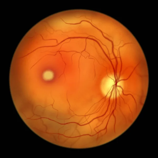Best Disease Best Vitelliform Macular Dystrophy Vitelliform Stage Classic Egg — Stock Photo, Image