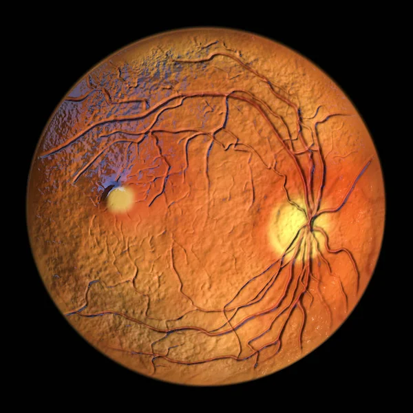 Best Disease Best Vitelliform Macular Dystrophy Vitelliform Stage Classic Egg — Stock Photo, Image