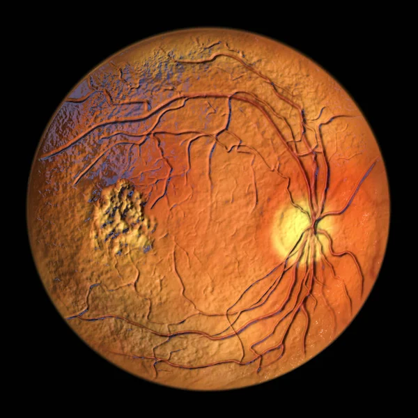 Best Disease Best Vitelliform Macular Dystrophy Vitelleruptive Stage Scrambled Egg — Stock Photo, Image