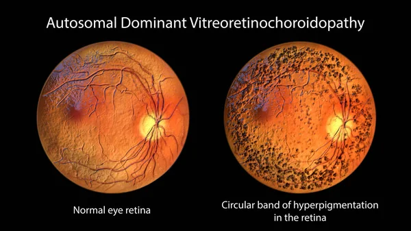 Autosomal Dominant Vitreoretinochoroidopathy Rare Genetic Disorder Affects Retina Illustration Showing — Stock Photo, Image