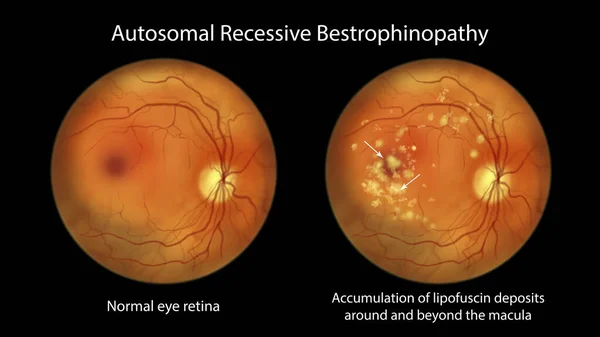 Autosomal Recessive Bestrophinopathy Scientific Illustration Showing Normal Eye Retina Accumulation — Stock Photo, Image