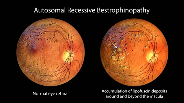 常染色体劣性ベストロフィノパシー 正常な眼網膜を示す3Dイラスト および網膜の進行的損傷につながるマクラの周りおよびそれ以降のリポフシン沈着物の蓄積 — ストック写真