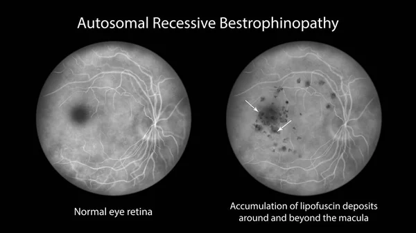 Autosomal Recessive Bestrophinopathy Illustration Showing Normal Eye Retina Accumulation Lipofuscin — Stock Photo, Image
