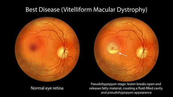 最高の病気 通常の眼の網膜と最高のビトリフォームの黄斑変性を示すイラスト リポフシンの層と緑膿菌の段階 眼鏡像ビュー — ストック写真