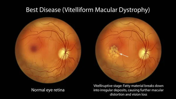 最高の病気 正常な眼の網膜と最高のビトリフォームの黄斑変性を示すイラスト スクランブルエッグの外観と水疱性病期 眼科視野 — ストック写真