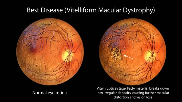 最高の病気 通常の目の網膜と最高のビトリフォームの黄斑変性を示す3Dイラスト スクランブルエッグの外観と水疱形成期 眼科視野 — ストック写真