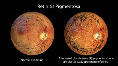 Pigmentosa 'yı yeniden başlatıyor, genetik bir göz hastalığı. 3 boyutlu illüstrasyon normal göz retinası ve zayıflamış kan damarları, pigmenter kemik baharatları ve etkilenen retinadaki optik diskin balmumu görünümünü gösteriyor.