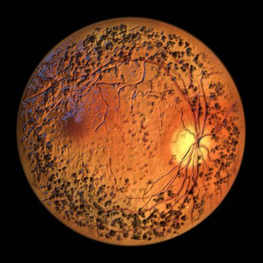 Otozomal baskın vitreoretinokoroidopati retina, vitröz ve koroidi etkileyen nadir görülen bir genetik bozukluk. Retinadaki dairesel hiperpigmentasyon bandını gösteren üç boyutlu çizimler.