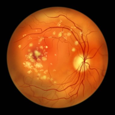 Otozomal çekinik bestrofenopati, optalmoskop görüntüsü, makula çevresinde ve ötesinde lipofusin birikimlerinin retinada ilerleyen hasara yol açtığını gösteren bilimsel çizimler.
