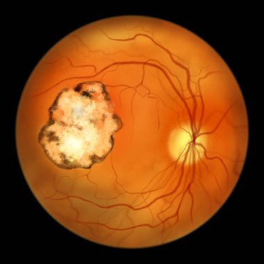 Retinal scar in toxoplasmosis, a disease caused by the single-celled protozoan Toxoplasma gondii, ophthalmoscope view, scientific illustration clipart