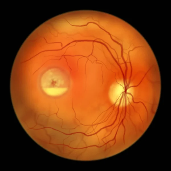 Best Disease Best Vitelliform Macular Dystrophy Pseudohypopyon Stage Layering Lipofuscin — Stock Photo, Image