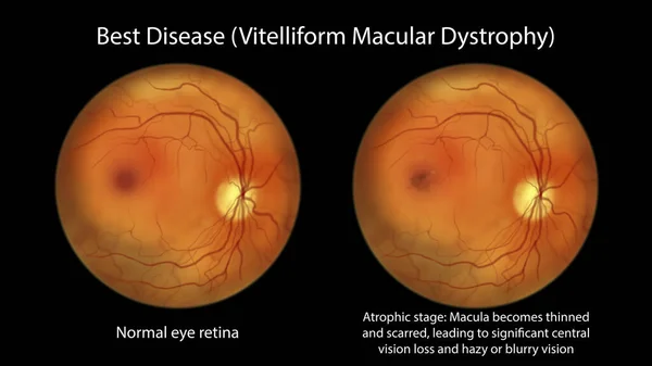 網膜萎縮や瘢痕形成を伴う萎縮病期における正常な眼網膜と最高のビトリフォームの黄斑変性を示すイラスト 眼間視野 — ストック写真
