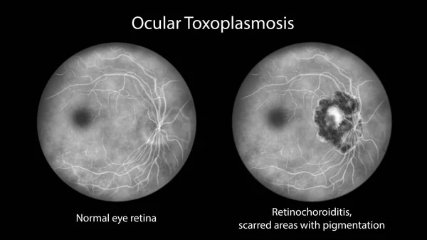 単細胞原虫のトキソプラズマ ゴンジイによって引き起こされる疾患であるトキソプラズマ症における網膜傷跡と 比較のための同じ健康的な眼網膜 蛍光血管造影 科学的イラスト — ストック写真