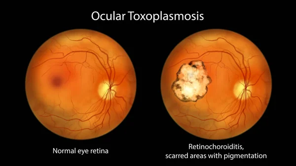 単細胞原虫のトキソプラズマゴンジィによって引き起こされる疾患であるトキソプラズマ症の網膜傷跡と 眼鏡像 科学的イラストのための同じ健康的な眼の網膜 — ストック写真