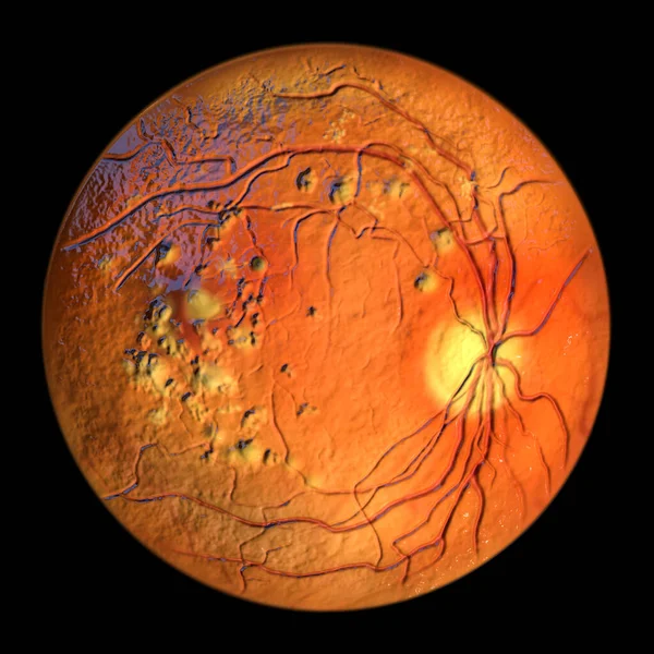 Autosomal Recessive Bestrophinopathy Ophthalmoscope View Illustration Showing Accumulation Lipofuscin Deposits — Stock Photo, Image