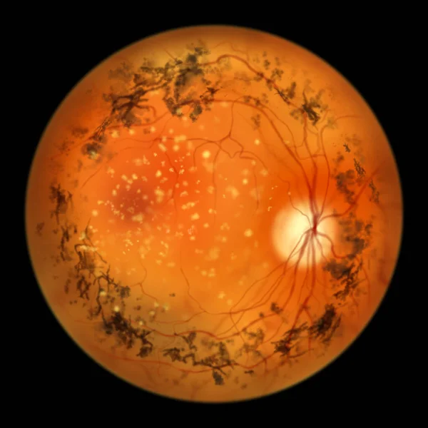Retinite Pigmentosa Uma Doença Ocular Genética Uma Ilustração Mostra Depósitos — Fotografia de Stock