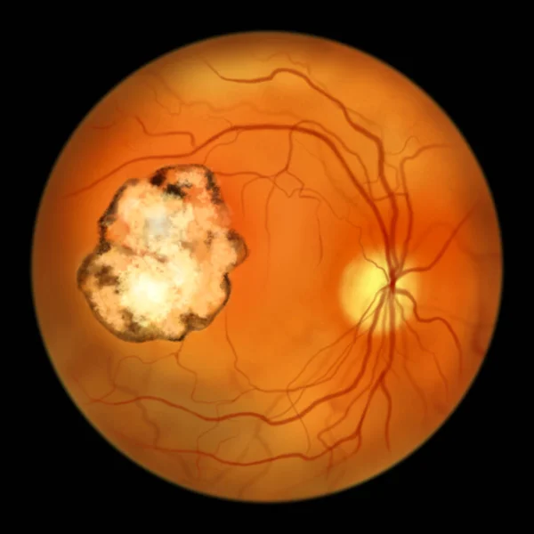 Retina Heg Toxoplazmózis Betegség Által Okozott Egysejtű Protozoan Toxoplasma Gondii — Stock Fotó