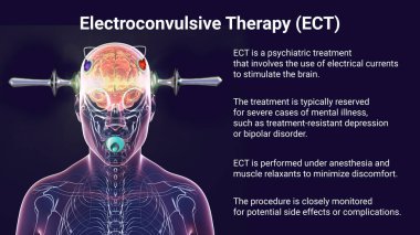 Elektrokonvülsif terapi, elektrokonvülsif terapi, beyin uyarılması için elektrik akımlarının kullanıldığı ağır akıl hastalıkları için kullanılan bir tedavi, 3 boyutlu illüstrasyon.