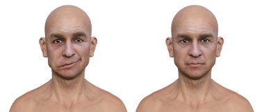 Bir erkekte yüz felci ve aynı sağlıklı adam, fotorealistik üç boyutlu resimleme yüz kaslarının bir tarafındaki asimetri ve düşüşü vurguluyor.