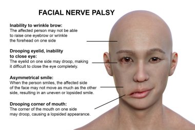 Bir erkekte yüz felci, fotorealistik üç boyutlu illüstrasyon yüz kaslarının bir tarafındaki asimetri ve düşüşü vurguluyor.