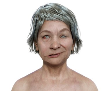 Bir kadında yüz felci, fotorealistik üç boyutlu resimleme yüz kaslarının bir tarafındaki asimetri ve düşüşü vurguluyor.