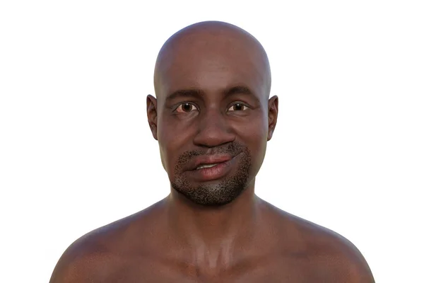アフリカ人男性の顔の麻痺 顔の片側の顔の筋肉の非対称性と垂下を強調するフォトリアリスティック3Dイラスト — ストック写真