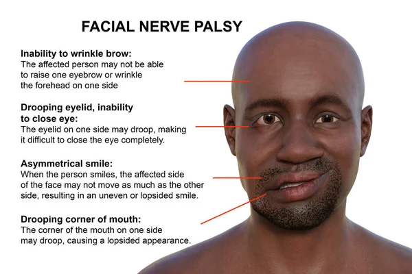 Facial palsy in an African man, photorealistic 3D illustration highlighting the asymmetry and drooping of the facial muscles on one side of the face