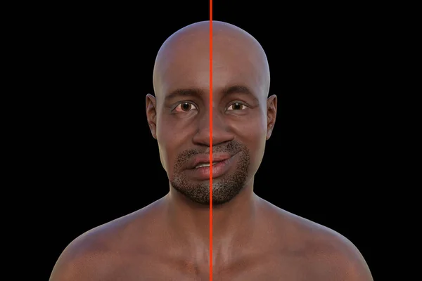 Facial palsy in an African man, photorealistic 3D illustration highlighting the asymmetry and drooping of the facial muscles on one side of the face