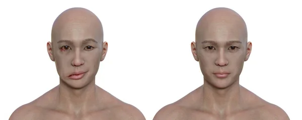 男性と同じ健康な男性の顔の麻痺 顔の片側に顔の筋肉の非対称性と垂下を強調フォトリアリスティック3Dイラスト — ストック写真