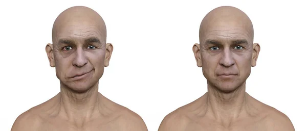 Paralisia Facial Homem Mesmo Homem Saudável Ilustração Fotorealista Destacando Assimetria — Fotografia de Stock