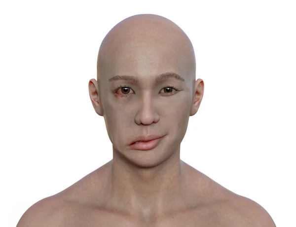 男性の顔の麻痺 顔の片側に顔の筋肉の非対称性と低下を強調するフォトリアリスティック3Dイラスト — ストック写真