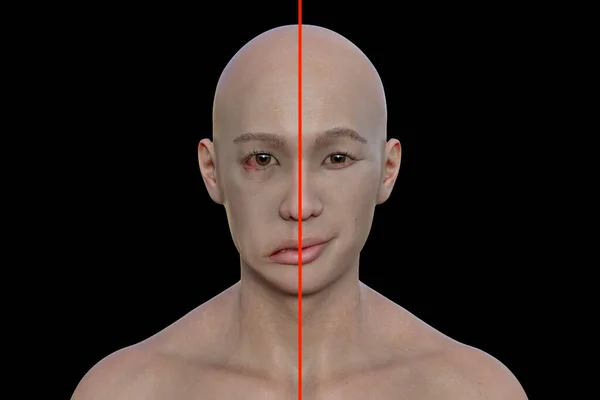 Facial palsy in a man, photorealistic 3D illustration highlighting the asymmetry and drooping of the facial muscles on one side of the face